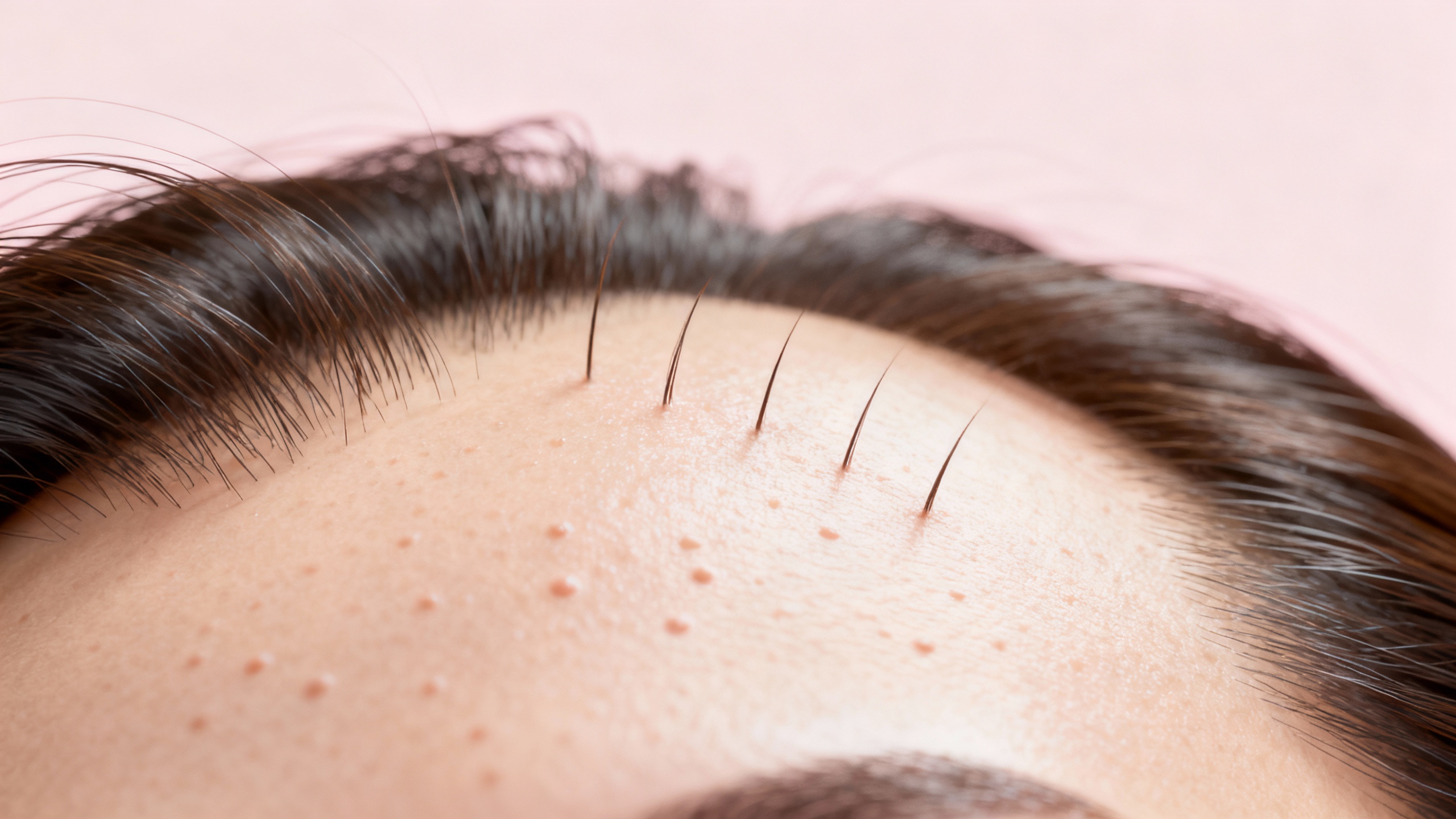 Featured image for Why do I get acne on my scalp?