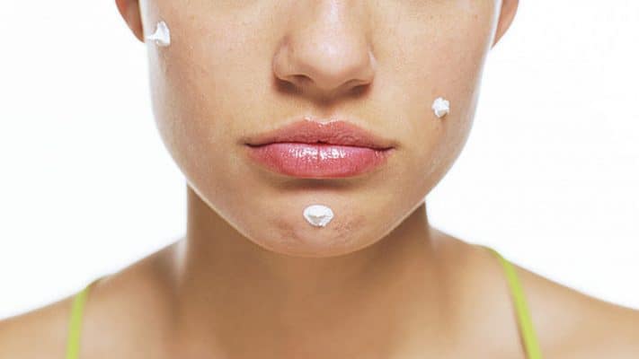 get acne free skin